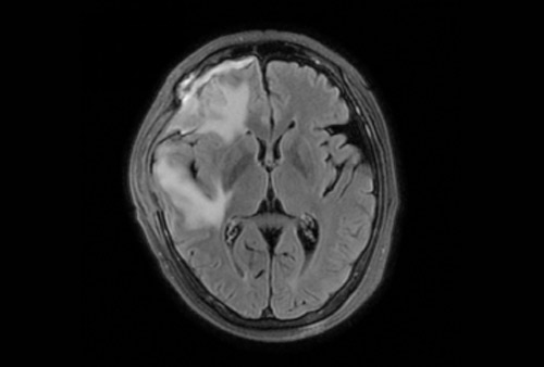 影像组学分析预测