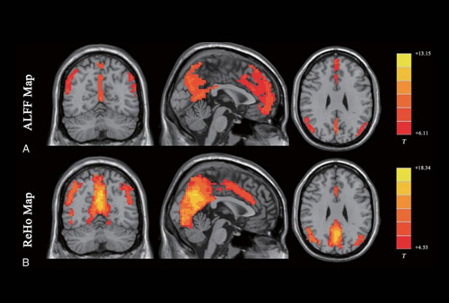 静息态功能磁共振（rs-fMRI）数据处理