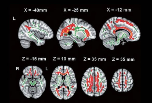 弥散磁共振（dMRI）数据处理