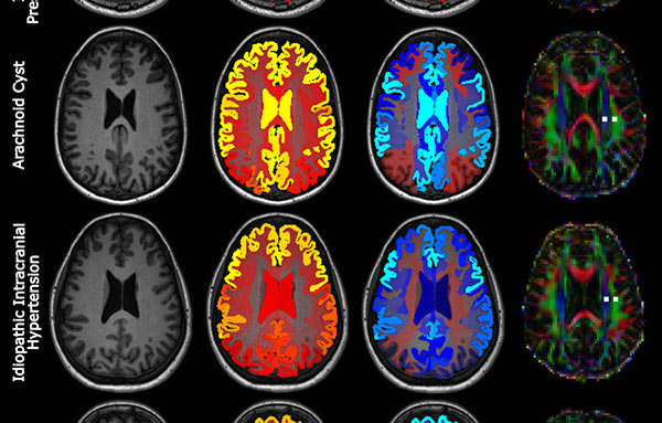 前沿速递 | 《Radiology》DTI-ALPS 指数与鞘内造影 MRI 的正面对决——非侵入性指数能否真正反映类淋巴系统功能？